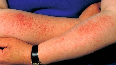 Sun Poisoning Rash, Heat Rash Remedy, Home Remedies For Rashes, Allergy Rash, Severe Sunburn, Rashes Remedies, Sun Allergy, Itchy Rash, Heat Rash