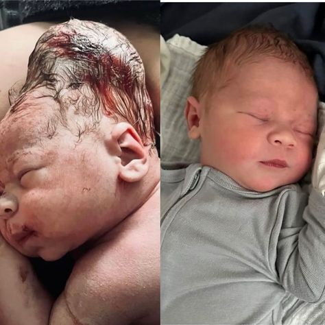 Birth never ceases to amaze me. First pic: baby’s head immediately following birth Second pic: baby’s head less than 24 hours after birth Measuring a baby’s head in utero is an estimation of information that falsely gives us a sense of prediction into the birth and introduces unnecessary interventions. Given the fact that baby’s heads are not fixed objects and the ultrasound also fails to tell us how much the baby’s skull plates can and will compress, overlap and mold to fit through the p... After Birth, Ultrasound, One Pic