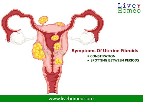 Women Reproductive System, Polyps Uterus, Spotting Between Periods, Uterine Polyps, Health Care Tips, Mammary Gland, Female Reproductive System, Fallopian Tubes, Reproductive System