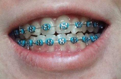 Braces Blue, Dental Braces Colors, Braces Colors Combinations, Blue Braces, Braces Retainer, After Braces, Braces Bands, Ceramic Braces, Cute Braces Colors