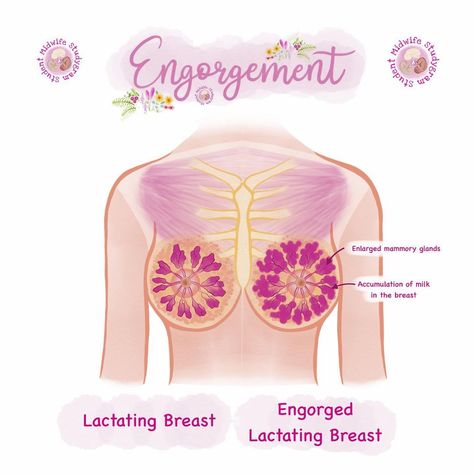 𝗦𝘁𝘂𝗱𝗲𝗻𝘁 𝗠𝗶𝗱𝘄𝗶𝗳𝗲 𝗦𝘁𝘂𝗱𝘆𝗴𝗿𝗮𝗺 on Instagram: “🤱🏾 Engorgement 🤱🏾 Initial physiological engorgement refers to the overfilling of the breasts, resulting in lymphatic and vascular…” Student Midwife Studygram, Midwife Aesthetic, Doula Quotes, Midwifery Student, Doula Business, Student Midwife, Nurse Manager, Nurse Study Notes, Mother Baby Nurse