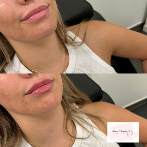 Stunning natural enhancement for this babe 😍👄💉 🖤 Restylane Kysse half syringe of lip filler 🖤 Appointment lasting 30-60 minutes 🖤 Results lasting up to 12 months 🖤 Common side effects include swelling and bruising 🖤 Numbing cream is used prior to procedure to ease with pain, as well as numbing agent in the lip filler itself 🖤 Direct message with any questions or click the booking link in bio for your FREE consultation! • • • • • #lipfiller #lipinjections #saskatchewan #cosmeticinjec... Cosmetic Injections, Cosmetic Injectables, Numbing Cream, Lip Filler, Lip Injections, Lip Fillers, 60 Minutes, Free Consultation, Side Effects