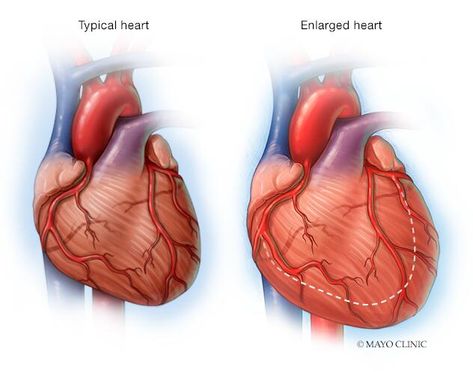 Enlarged Heart Symptoms, Heart Symptoms, Enlarged Heart, Heart Muscle, Coronary Arteries, Heart Conditions, Healthy Lifestyle Changes, American Heart Association, Shortness Of Breath