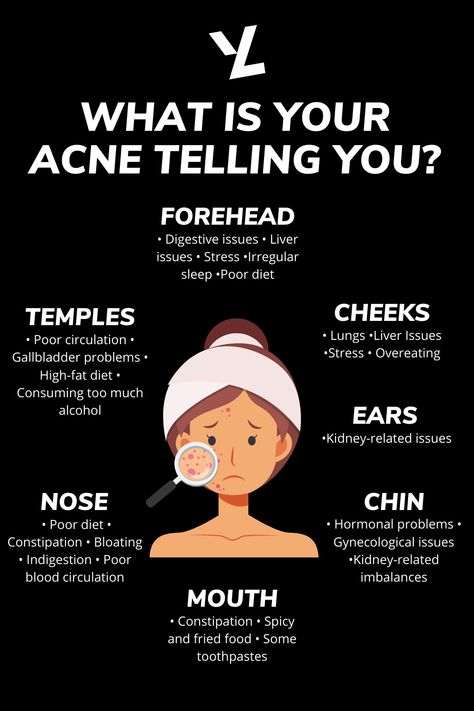 Clear Chin Acne, Where Acne Is And What It Means, What Does My Acne Mean, Acne Placement Meaning, Aesthetician School, Hormone Healing, Causes Of Acne, Different Types Of Acne, Liver Issues