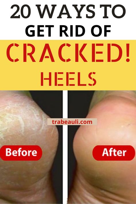 How to take care of cracked heels and some foot masks to fix cracked heels, you should know the reason behind having cracked heels!? Well, just with simple tips and tricks foot care home remedies you can have amazingly soft and smooth feet even during winters. #crackedheels #feetcare #homeremediesforfeet #remedy How To Get Smooth Heels, How To Get Rid Of Heel Cracks, How To Get Rid Of Rough Heels, How To Make Feet Soft And Smooth, Smooth Feet Remedies, Dry Cracked Feet Remedy, Cracked Heel Remedy, Soft Feet Remedy, Cracked Feet Remedies