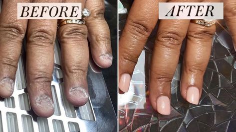 How This Manicurist Transformed Her Client’s Bitten Nails | Allure Bitten Nails, Fix Broken Nail, Manicure Pictures, Nails After Acrylics, Nail Problems, Ten Nails, Broken Nails, Nail Repair, Nails Green