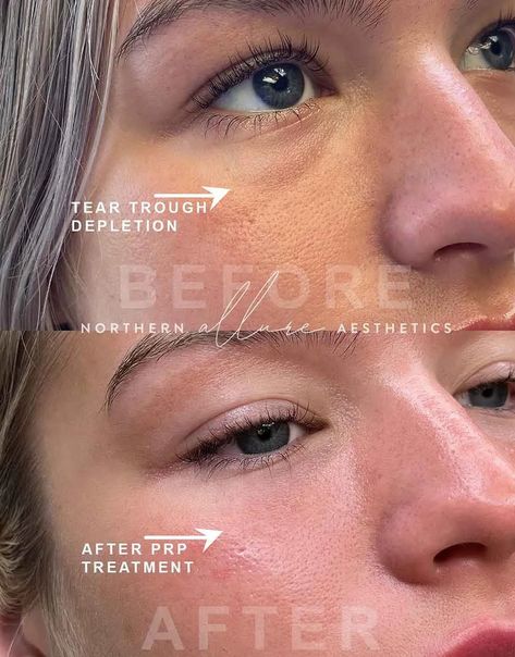 Under Eye Prp Before And After, Prp Before And After, Prp Microneedling Before And After, Prp Undereye Before And After, Vampire Facial Before And After, Vivace Microneedling, Microneedling Before And After, Prp Microneedling, Prp Facial