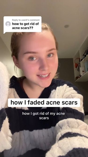 How To Fix Acne Scarring, Acne Scar Skin Care Routine, Body Acne Remedies, Natural Remedies For Acne, Remedies For Acne, Korean Skin Care Secrets, Serious Skin Care, Skin Care Tutorial, Healthy Skin Tips