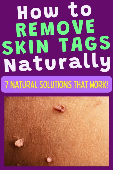 Image of skin tags. Text reads "How to remove skin tags naturally. 7 natural solutions that work!". Skin Tags Essential Oils, Skin Tags Apple Cider Vinegar, Remove Skin Tags, Apple Cider Vinegar For Skin, Remove Skin Tags Naturally, Natural Hair Growth Remedies, Home Remedies For Skin, Essential Oils For Pain, Skin Growths