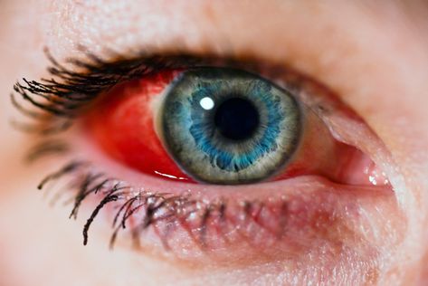 Blood Vessel In Eye, Prevent Aging, Blood Vessels, Medical