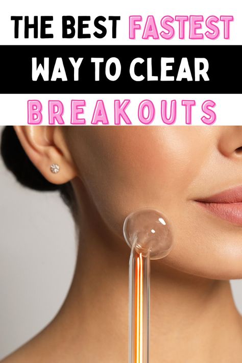 The Best Skin Treatments To Clear Breakouts Fast Clear Up Acne Fast, Skin Treatments For Acne, Treatments For Acne, Comedonal Acne, Clear Up Acne, Acne Mask, Acne Dark Spots, Dark Spots On Skin, Acne Breakout