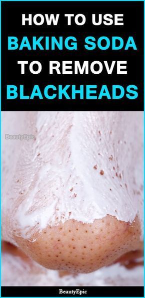 Baking Soda For Blackheads, Baking Soda Shampoo Recipe, Baking Soda Face, For Blackheads, Baking Soda Water, Black Heads, Hormonal Balance, Remove Blackheads, Baking Soda Uses