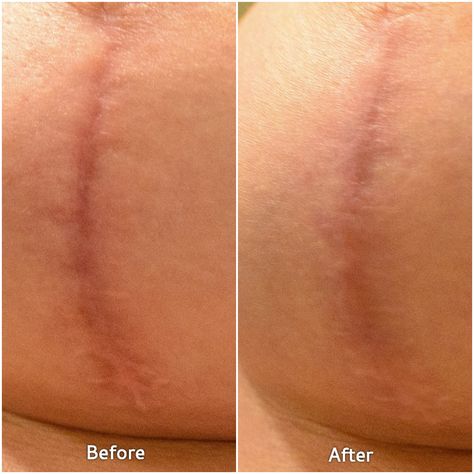 Healing from Surgery with Embrace Scar Therapy - The Road Les Traveled Scar Healing Remedies, Healing From Surgery, Scar Healing, Mastectomy Scars, Scar Remedies, Mastectomy Recovery, Breast Lift Surgery, Double Mastectomy, Hypertrophic Scars