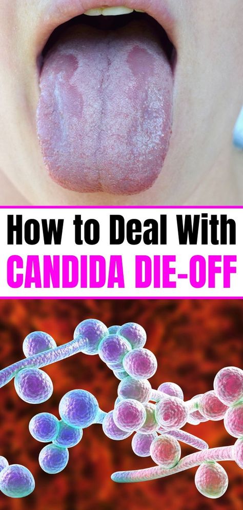 Candida Die Off Symptoms and Remedies. When you go on a Candida Diet, it’s hard enough that you have to restrict or eliminate certain foods, but dealing with candida die-off can make the whole situation miserable.It’s important to know how best to deal with yeast die-off so you can manage symptoms and get to the root of the problem without giving up. Candida Die Off, Die Off Symptoms, Candida Cleanse Diet, Get Rid Of Candida, Calf Cramps, Candida Diet Recipes, Candida Cleanse, Candida Overgrowth, 12 Minute Workout