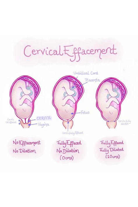 The meaning of cervical dilation, effacement and signs you are dilating -
https://womensintegrativehealthny.com/what-is-cervical-effacement/?utm_campaign=ds&utm_medium=ds&utm_source=ds&OwnerID=6012595 Cervical Effacement, Cervical Fusion, Cervical Dilation, Preconception Planning, Cervical Disc, Fertility Help, Thyroid Issues, Natural Birth, Healthy Pregnancy