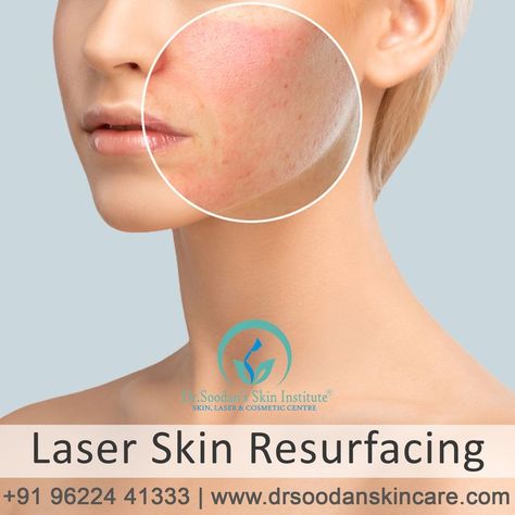 If ageing, acne, or too much time in the sun has left your face with blotches, scars, wrinkles, or lines, laser skin resurfacing may help your skin look younger and healthier. Book An Appointment Now! Whatsapp 📲 98269 44686 Call �📞 0731 4998601 #drshuken #dhlskincentre Laser Skin Resurfacing, Skin Resurfacing, Laser Skin, Book An Appointment, Look Younger, Too Much, Wrinkles, The Sun, Acne