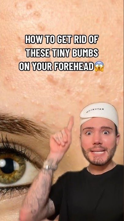 HOW TO GET RID OF FORHEAD BUMPS!😱(follow for more💗) #skincare #acne #skin #skincareroutine #beauty What Helps With Pimples, How To Get Rid Of Pimple Bumps On Face, Bumps On Face How To Get Rid Of, Face Bumps Get Rid Of, How To Get Rid Of Heat Bumps On Face, How To Get Rid Of A Cystic Pimple, How To Get Rid Of Heat Bumps, Fastest Way To Get Rid Of Pimples, Forehead Pimples Remedies