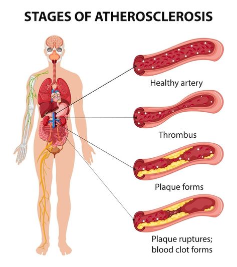 Coronary Arteries Disease, Anatomy Organs, Coronary Artery, Nursing School Essential, Educational Infographic, Coronary Arteries, Medical Anatomy, Cardiology, Book Images