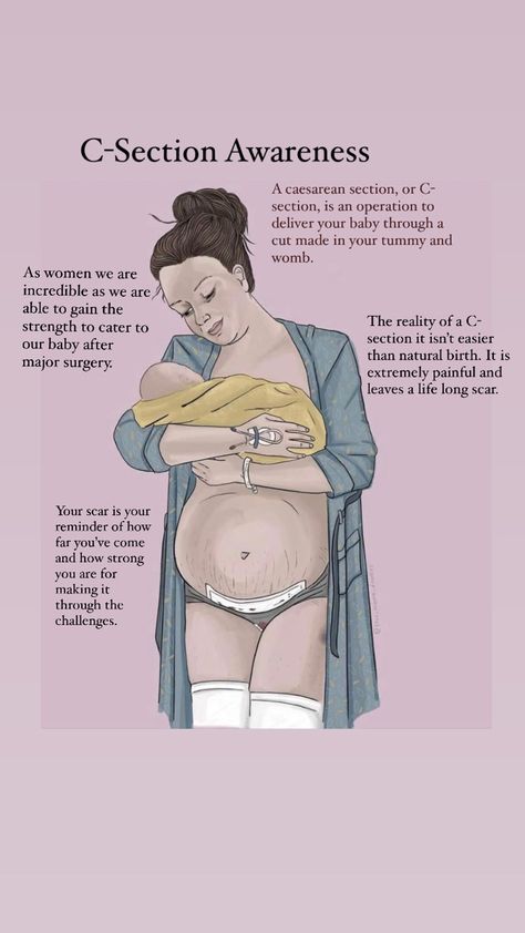 C Section Recovery Quotes, Cesarean Section Quotes, C Section Art, C Section Quotes Inspiration, C Section Awareness Month Quotes, C Section Mom Quotes, Pregnancy Journey Quotes, Post Partum Quotes Mothers, C Section Quotes