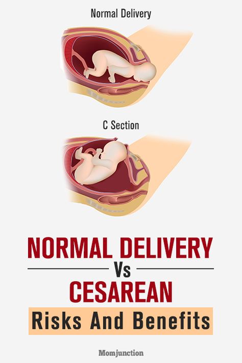 C-Section Vs. Normal Delivery: How Are They Different Normal Delivery Tips, Biological Facts, Medical Sutures, Bedding Master, Normal Birth, Birth Delivery, Cesarean Delivery, Birth Plan Template, C Section Recovery