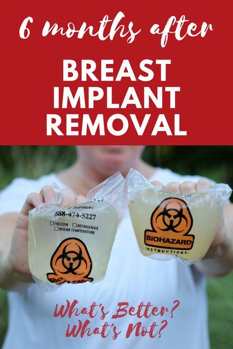 Breast Implant Removal || Explant || Healing Breast Implant Illness || Life after breast implants || 6 months post breast implant removal Explant Surgery, Breast Implant Removal, Implant Removal, Mthfr Gene Mutation, Breast Implant Illness, Breast Surgery, Breast Lift, Breast Augmentation, St Jude