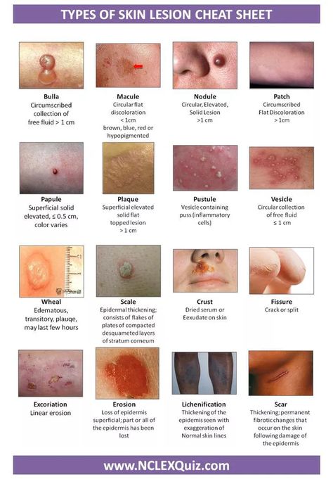 MEDizzy - Types of Skin Lesion Cheat Sheet Anatomy Revision, Nurses Notes, Wound Care Nursing, Medical Assisting, Skin Lesions, Nurse Practitioner School, Nursing Information, Nursing Assessment, Community Nursing