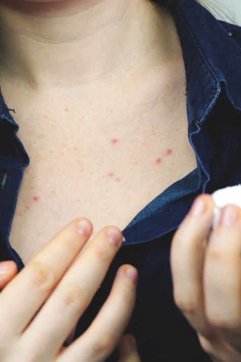 How to Treat Chest Acne, According to Dermatologists Shoulder Acne, Back Acne Remedies, Chest Acne, Forehead Acne, Natural Acne Remedies, How To Get Rid Of Pimples, Body Acne, Popsugar Beauty, Cystic Acne