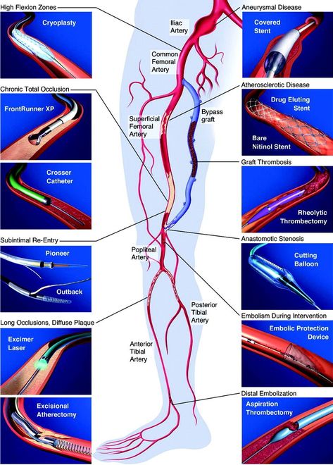 Effective home remedies for the natural elimination of varicose veins Medical Sonography Student, Diagnostic Medical Sonography Student, Ultrasound School, Cardiac Sonography, Medical Terminology Study, Vascular Ultrasound, Sonography Student, Medical Sonography, Ultrasound Sonography