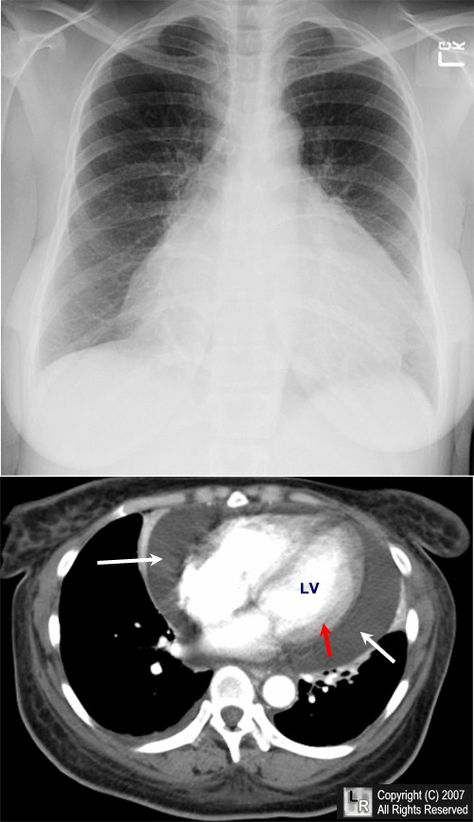 Pericardial effusion. Frontal chest radiograph (above) demonstrates a markedly enlarged cardiac silhouette. The differential diagnosis would include cardiomyopathy and pericardial effusion. A single axial, contrast-enhanced CT scan of the chest at the level of the heart shows a large pericardial effusion (white arrows) surrounding the contrast-filled heart. The red arrow points to the myocardium. Chest Ct Scan, Heart Xray, Heart Scan, Cardiac Tamponade, Bottle Silhouette, Pericardial Effusion, Radiologic Technology, Enlarged Heart, Natural Decongestant