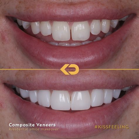 Dental Composite Veneer, Composite Bonding Before And After, Veneers Before And After, Composite Bonding Teeth, Teeth Composite, Teeth Makeover, Dental Cover, Teeth Bonding, Composite Bonding