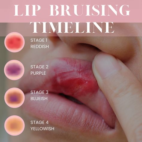 After getting lip filler, you may be surprised by the level of swelling, bruising, and tenderness you are left with. You’ve probably wondered how long does does the lip filler bruising last?

Everyone heals differently and this is down to their own anatomy, typically if our clients experience bruising this is the common time frame that it lasts for: 
Stage 1 Reddish - Immediately after treatment
Stage 2 Purple - 2-3 days
Stage 3 Blueish - 5-7 days
Stage 4 Yellowish - 1 - 2 weeks

Speak to us imm Facial Fillers, Lip Augmentation, Lip Filler, Lip Injections, Black Lips, Lip Fillers, Natural Lips, The Pretty, Anatomy