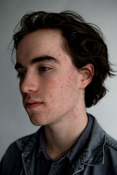 Pimples, acne and blemishes are completely beautiful and this is why Guys With Acne, Male Acne, Pimple On Face, Pimple Face, Acne Men, 2 Wolves, Pimples On Face, Gender Norms, Five Guys