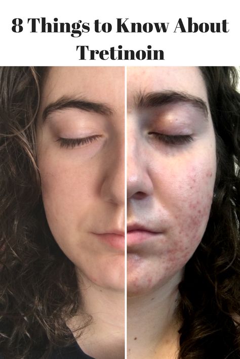 Tretinoin Before And After Acne, Tretinoin Acne, Tretinoin Before And After, Before And After Acne, Combination Skin Face Wash, Acne Scaring, Tretinoin Cream, Acne Tips, Clear Skin Fast