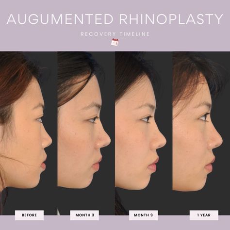 Flat Nose Asian, Medical Safety, Bulbous Nose, Rhinoplasty Surgery, Types Of Surgery, Nose Surgery, Perfect Nose, Facial Plastic Surgery, Flat Nose