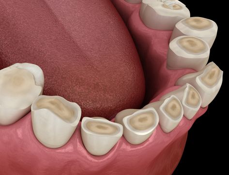 Dental Pictures, Misaligned Teeth, Tooth Filling, Dental Decay, Teeth Grinding, Dental Cavities, Gastrointestinal Disorders, Dental Facts, Tooth Sensitivity