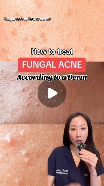 Jenny Liu, MD FAAD , Skincare expert on Instagram: "Tips for managing “fungal acne”:

Start with an anti-dandruff shampoo, use like a cleanser/body wash, leave on for few minutes then rinse off. Topical otc anti fungal creams may also be benefits 

However often the pityrosporum yeast is deeper in the hair follicles and require a course of oral medication for best response 

Drop any questions you have below 

#pityrosporumfolliculitis #fungalacne #acnecommunity #acnetips #dermatologist" How To Clear Fungal Acne Naturally, Dandruff Shampoo For Acne, Nizoral For Fungal Acne, How To Treat Fungal Acne, Fungle Acne, Fungal Acne Skin Care Routine, Apple Cider Vinegar For Acne, Cream For Acne, Acne Routine