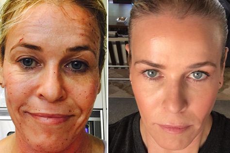 “Its f—ing awesome and no one is paying me to tell you about it. Bam!” Handler said Profractional Laser, Skin Mask Diy, Acne Scar Mask, Laser Resurfacing, Acne Overnight, Diy Acne, Chelsea Handler, Acne Scar Removal, Skin Resurfacing