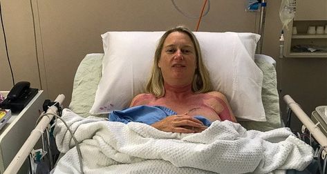 My Bilateral Mastectomy with Tissue Expanders - Josie's Journey Mastectomy Reconstruction, Mastectomy Recovery, Bilateral Mastectomy, Body Inflammation, Breast Reconstruction, Breast Surgery, Lymph Nodes, I Decided, Home Page