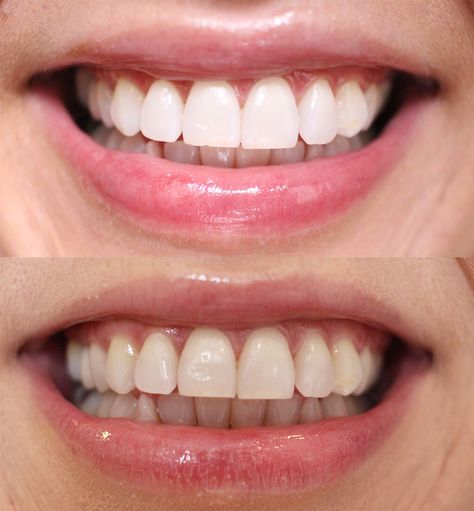 Dental Photos, Alcohol Free Mouthwash, Sensitive Teeth Remedy, Dental Photography, Teeth Whitening Remedies, Teeth Bleaching, Teeth Implants, Natural Teeth Whitening, Coffee Staining