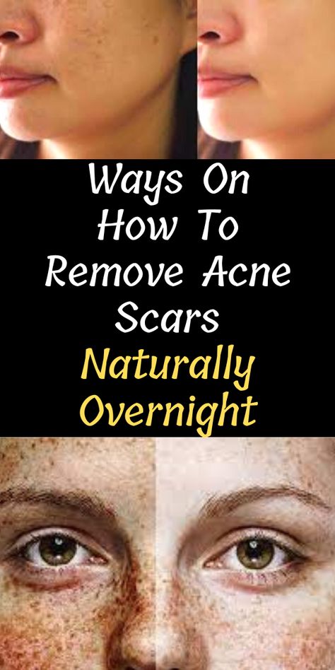 Ways On How To Remove Acne Scars Naturally Overnight - She Made by Grace Clear Acne And Scars, Natural Acne Scar Removal, Acne Scab, Best Acne Scar Removal, Acne Scaring, Blind Pimple, Pimples Under The Skin, Acne Overnight, Natural Acne