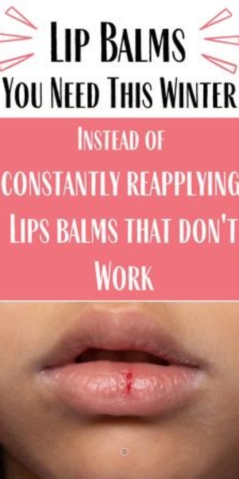 Dry Lips Remedy Overnight How To Get Rid, How To Keep Your Lips Moisturized, Best Lip Balm For Chapped Lips, Severe Chapped Lips, How To Get Rid Of Chapped Lips, Diy Lip Mask Overnight, How To Get Rid Of Dry Lips, Dry Lips Remedy Overnight, Cut On Lip