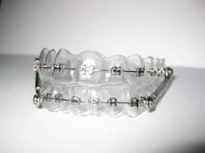 Clear Retainers and Fake Braces Tmj Relief Remedies, Fake Braces, Removable Braces, Fixed Braces, Tmj Relief, Clear Retainers, Cute Braces Colors, Adult Braces, Cute Braces