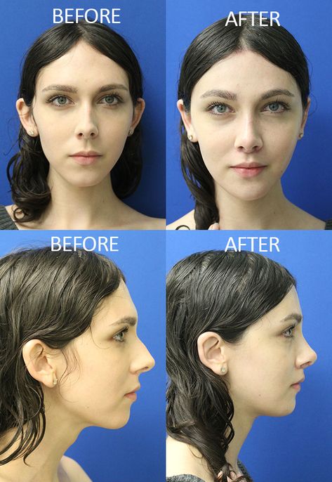 Facial Feminization Surgery | Transgender FFS Surgeon Florida Ffs Surgery, Jaw Reduction Surgery, Rhinoplasty Recovery, Face Plastic Surgery, Nose Surgery Rhinoplasty, Plastic Surgery Fail, Korean Plastic Surgery, Rhinoplasty Nose Jobs, Woman Tips