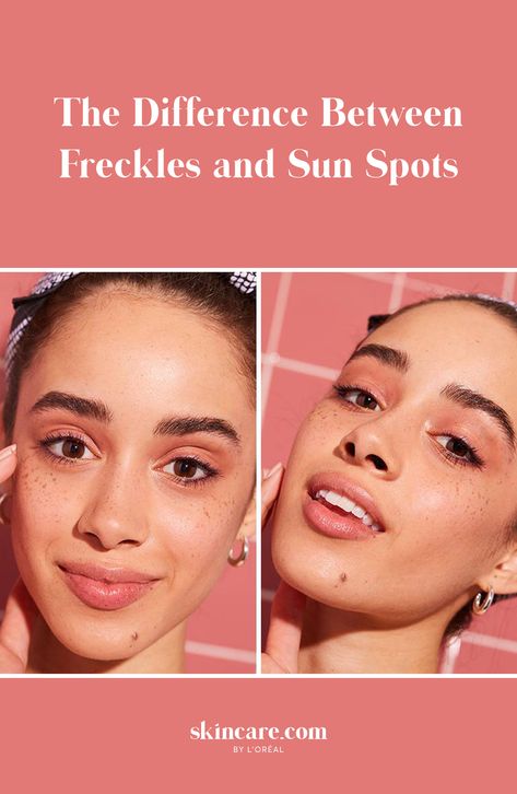 With the excessive amounts of time spent in the sun recently, it can be difficult to differentiate between freckles and sun spots. Both of these pigmented spots tend to appear after too much sun exposure, yet they're inherently different. Learn the truth about your own skin and avoid any future sun damage with the tips in our article! #summerskin #sunspots #freckles #skinbeauty #summerbeauty Sun Freckles, Sun Spot, Skincare Advice, Brown Spots Removal, Dark Under Eye, Summer Skin, Skin Discoloration, Sun Exposure, Broad Spectrum Sunscreen