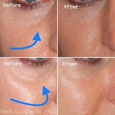 Trough Filler Before After, How To Get Rid Of Tear Troughs, Eye Trough Filler, Derma Fillers Before And After, Tear Through Eye Filler, Undereye Fillers Before And After, Tear Through Filler Before And After, Tear Trough Remedy Natural, Eye Trough Filler Before And After