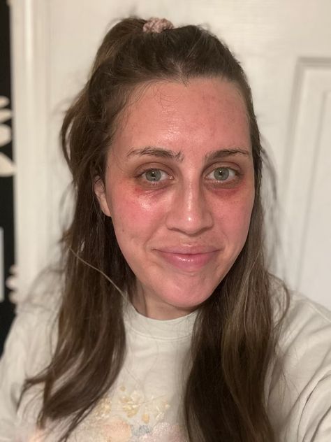 I Tried Microneedling, & My Dark Under-Eye Circles Have Never Looked Better Dark Circles Aesthetic, After Microneedling, Microneedling With Prp, Under Eye Dark Circles, Dark Under Eye Circles, Dark Eye Circles, Numbing Cream, Dark Circles Under Eyes, Dark Under Eye