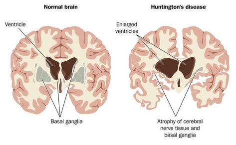 brain atrophy Rare Genetic Disorders, Art Of Animation Resort, Cells And Tissues, Reactive Oxygen Species, Endocannabinoid System, Adequate Sleep, Genetic Disorders, Aids Hiv, Lack Of Sleep