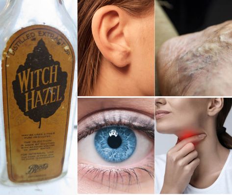 Uses for Witch Hazel - Home and Gardening Ideas Diy Witch Hazel, Using Witch Hazel On Face, Witch Hazel And Aloe Vera, What Is Witch Hazel Good For, Witch Hazel Skin Care, Benefits Of Witch Hazel, Clogged Ears, Hemorrhoid Remedies, Witch Hazel Uses