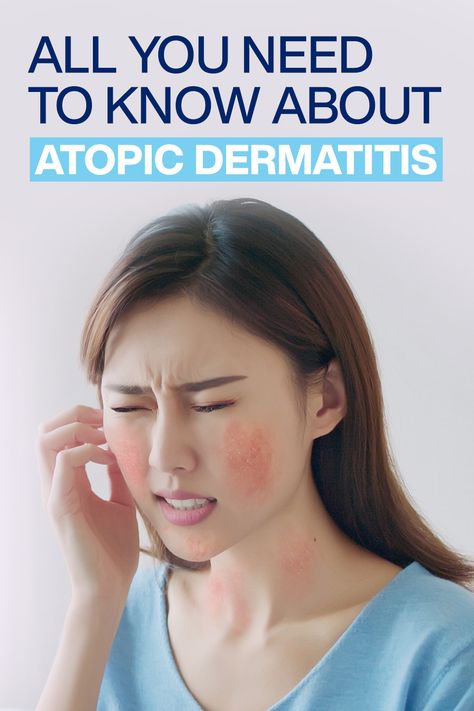 Are you seeking ways to treat atopic skin effectively? Discover here causes  and  effective solutions and everything you need to know about Atopic Dermatitis. Atopic Skin Care, Atopic Skin, Wellness Habits, Dry Sensitive Skin, Health Habits, Improve Mental Health, Health Check, Skin Concern, Hydrate Skin