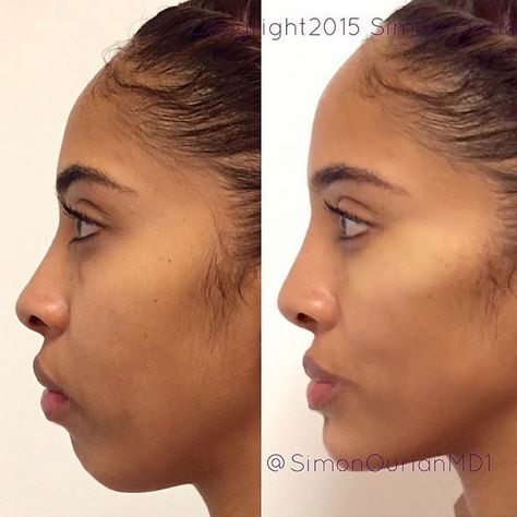 Dr. Simon Ourian - Epione sur Instagram : « Nonsurgical cheek & chin augmentation. Before (left) and after (right) of nonsurgical cheek lift and augmentation plus chin… » Rhinoplasty Recovery, Chin Filler, Vicki Gunvalson, Chin Augmentation, Cheek Lift, Chin Implant, Face Fillers, Hair Implants, Cheek Fillers